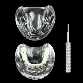 1 Chiếc Nha Khoa 4 Cấy Mô Hình Quá Răng Phục Hồi Maxillary Có Thể Tháo Rời Typodont Răng Mô Hình Giảng Dạy Nha Khoa Mô Hình Nghiên Cứu Mới
