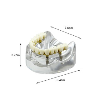 1 Chiếc Nha Khoa 4 Cấy Mô Hình Quá Răng Phục Hồi Maxillary Có Thể Tháo Rời Typodont Răng Mô Hình Giảng Dạy Nha Khoa Mô Hình Nghiên Cứu Mới