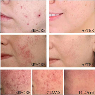 Huyết thanh axit salicylic thông thường