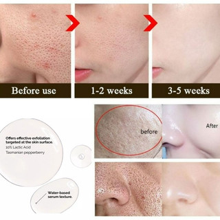 The Ordinary Lactic Acid Peeling Serum For Face Dark Spot Remover Brightening Moisturizer Pimple Remover Acne Scars Skin Care