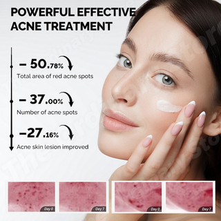 The Ordinary Azelaic Acid Cream Squalane Cleanser Sunscreen For Face Wash Pimple Remover Acne Scars And Pores Dark Spot Remover Brightening UV Protection Skin Care