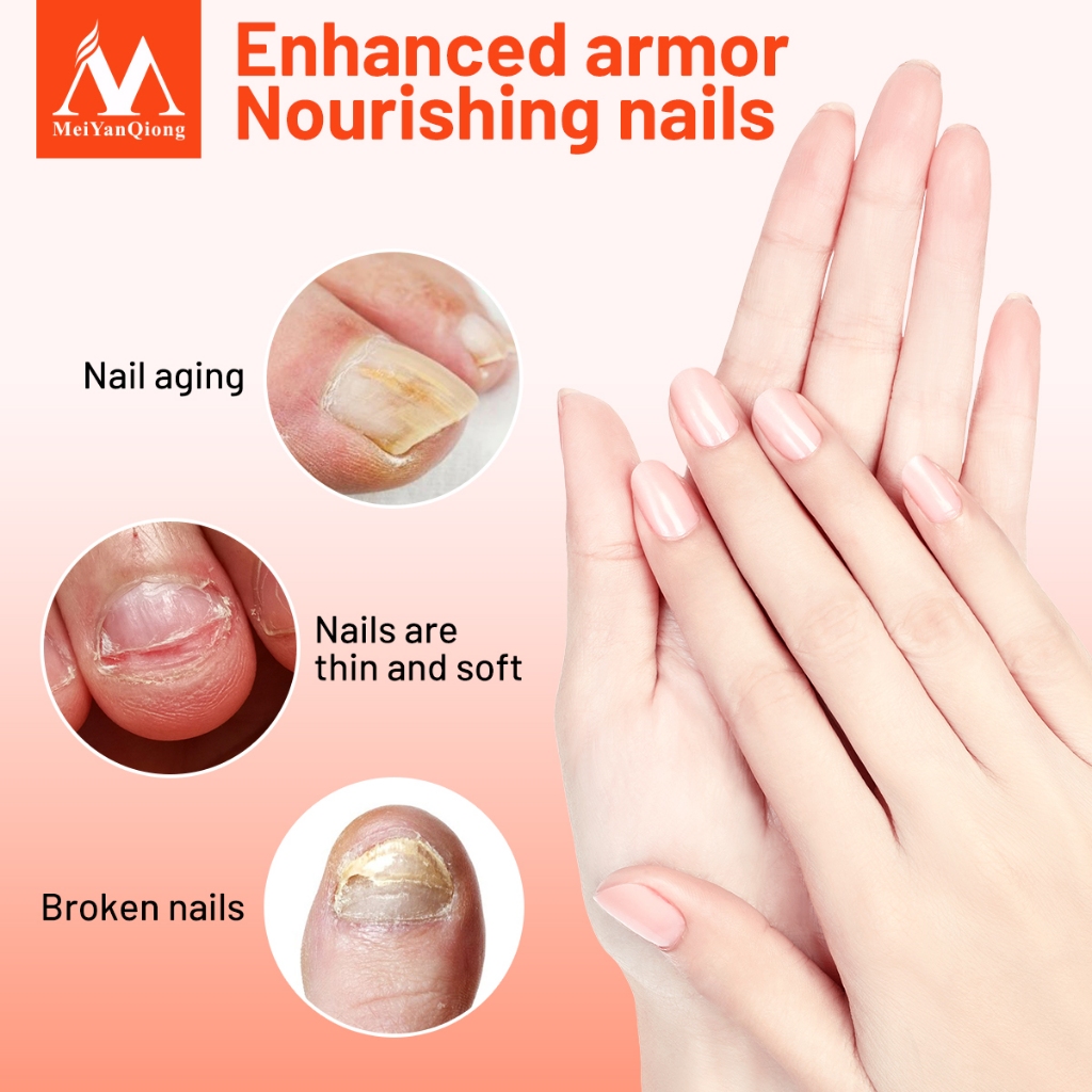 MeiYanQiong Tinh Chất Trị Nấm Móng Tay / Chân Loại Bỏ Nấm Móng 30ml