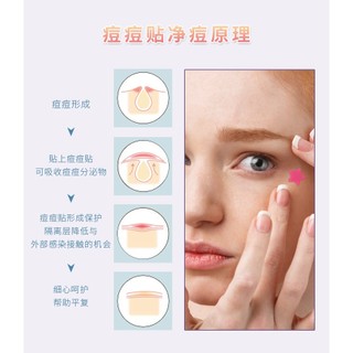 Miếng Dán Mụn Hình Sao AURA | Hydrocolloid Hút Dịch • Thoáng Khí • Dễ Bóc • Giảm Mụn Nhanh • #DDT01