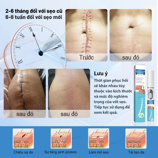Bút laser xóa nhanh - sẹo lồi, sẹo phẫu thuật, sẹo bỏng, sẹo trẻ em