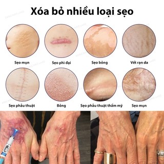Bút laser xóa nhanh - sẹo lồi, sẹo phẫu thuật, sẹo bỏng, sẹo trẻ em