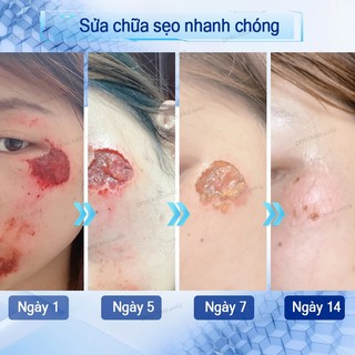 Bút laser xóa nhanh - sẹo lồi, sẹo phẫu thuật, sẹo bỏng, sẹo trẻ em