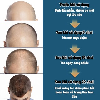 Tinh chất hỗ trợ tăng trưởng tóc, giảm hói đầu, rụng tóc areata, rụng tóc Địa Trung Hải, rụng tóc bẩm sinh