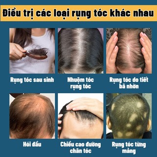 Tinh chất hỗ trợ tăng trưởng tóc, giảm hói đầu, rụng tóc areata, rụng tóc Địa Trung Hải, rụng tóc bẩm sinh