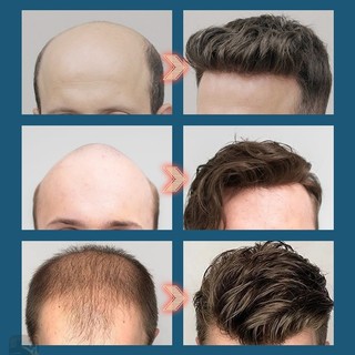 Tinh chất hỗ trợ tăng trưởng tóc, giảm hói đầu, rụng tóc areata, rụng tóc Địa Trung Hải, rụng tóc bẩm sinh