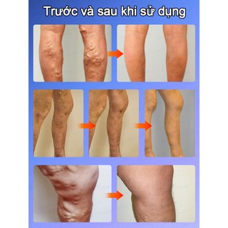 [Nhập khẩu từ Hàn Quốc] Loại bỏ tĩnh mạch Laser có thể giảm đau, giúp giảm giãn tĩnh mạch, ngăn ngừa giãn tĩnh mạch và làm dịu chân