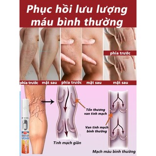 Giảm Tĩnh Mạch Bút Laser Chân Ánh Sáng Sóng Chăm Sóc Giảm Va Đập Di Động Không Thoải Mái Thích Hợp Cho Người Cao Tuổi Trung Niên​