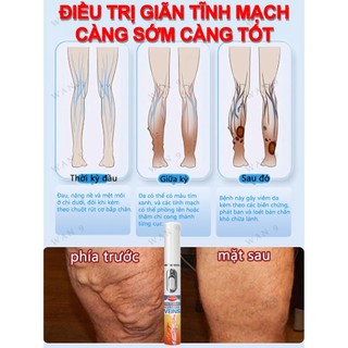 Giảm Tĩnh Mạch Bút Laser Chân Ánh Sáng Sóng Chăm Sóc Giảm Va Đập Di Động Không Thoải Mái Thích Hợp Cho Người Cao Tuổi Trung Niên​