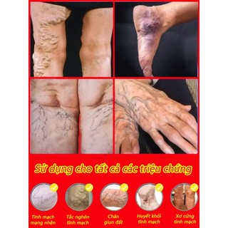 Giảm Tĩnh Mạch Bút Laser Chân Ánh Sáng Sóng Chăm Sóc Giảm Va Đập Di Động Không Thoải Mái Thích Hợp Cho Người Cao Tuổi Trung Niên​