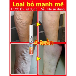 Giảm Tĩnh Mạch Bút Laser Chân Ánh Sáng Sóng Chăm Sóc Giảm Va Đập Di Động Không Thoải Mái Thích Hợp Cho Người Cao Tuổi Trung Niên​