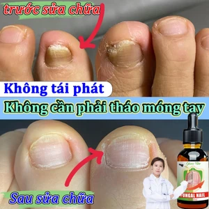 Serum điều trị nấm móng tay/chân, không tái phát, không cần loại bỏ móng