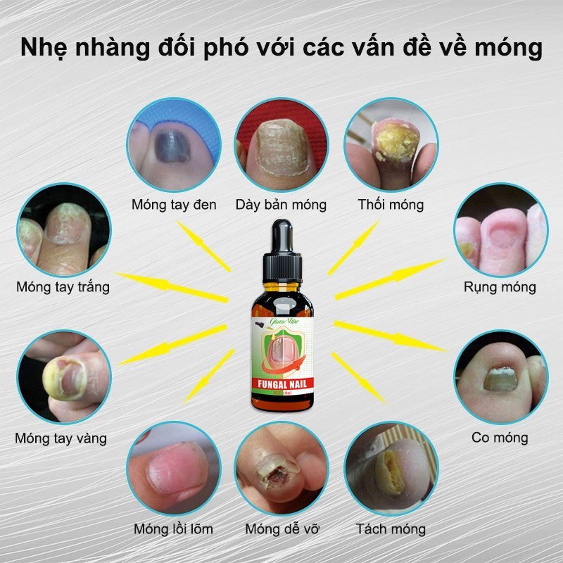 Serum điều trị nấm móng tay/chân, không tái phát, không cần loại bỏ móng