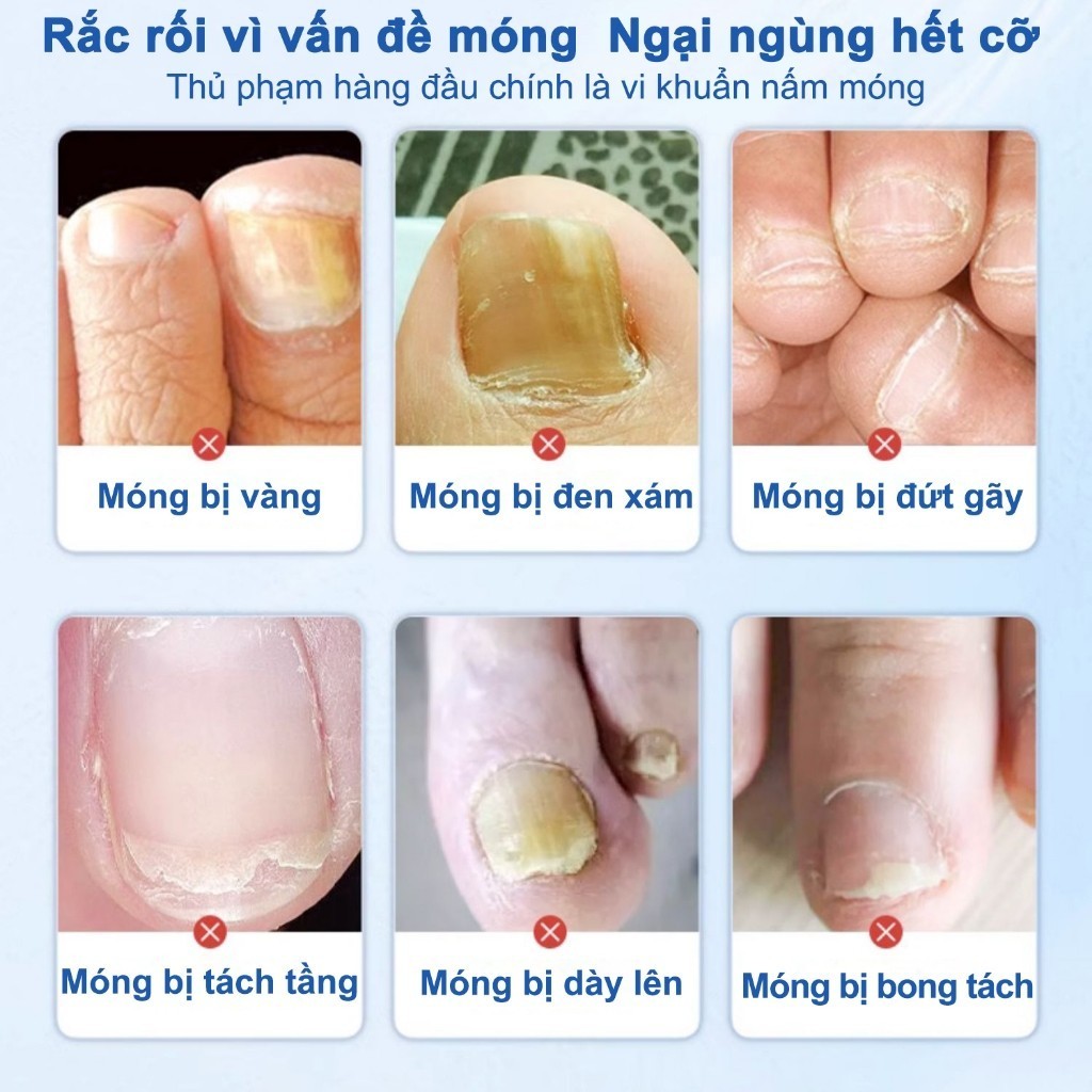 Serum điều trị nấm móng tay/chân, không tái phát, không cần loại bỏ móng