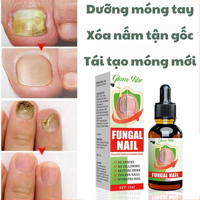 Serum điều trị nấm móng tay/chân, không tái phát, không cần loại bỏ móng