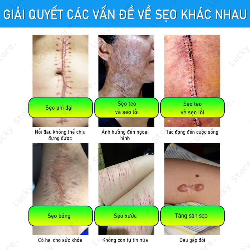 Kem loại bỏ sẹo hiệu quả sau 7 ngày cho sẹo cũ, sẹo phẫu thuật, giảm thâm mụn