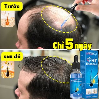 Tinh chất hỗ trợ tăng trưởng tóc, giảm hói đầu, rụng tóc areata, rụng tóc Địa Trung Hải, rụng tóc bẩm sinh
