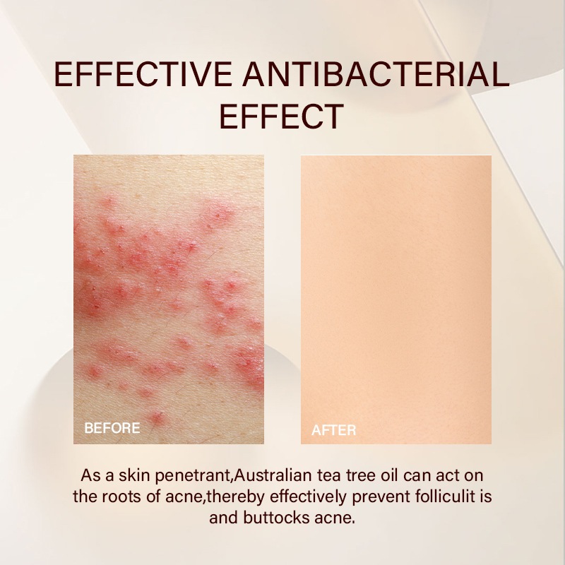 Sữa rửa mặt Hỗ trợ giảm mụn YOOJ Butt Acne Clear Lotion với dầu cây trà, và tẩy tế bào chết Hỗ trợ giảm mụn mông 100ML