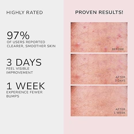 Sữa rửa mặt Hỗ trợ giảm mụn YOOJ Butt Acne Clear Lotion với dầu cây trà, và tẩy tế bào chết Hỗ trợ giảm mụn mông 100ML