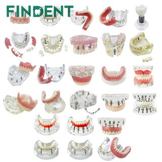 1 Cái Trên / Dưới Mô Hình Cấy Ghép Nha Khoa Hàm 2 / 4 / 6 Cấy Răng Mô Hình Giảng Dạy Nha Khoa Có Thể Tháo Rời Mô Hình Nghiên Cứu Cho Giáo Dục Demo