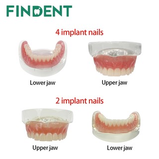 1 Cái Trên / Dưới Mô Hình Cấy Ghép Nha Khoa Hàm 2 / 4 / 6 Cấy Răng Mô Hình Giảng Dạy Nha Khoa Có Thể Tháo Rời Mô Hình Nghiên Cứu Cho Giáo Dục Demo