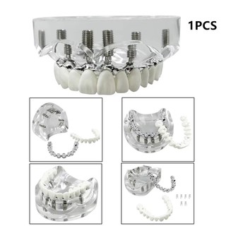 1 Cái Trên / Dưới Mô Hình Cấy Ghép Nha Khoa Hàm 2 / 4 / 6 Cấy Răng Mô Hình Giảng Dạy Nha Khoa Có Thể Tháo Rời Mô Hình Nghiên Cứu Cho Giáo Dục Demo