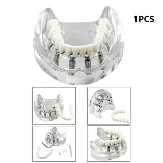 1 Cái Trên / Dưới Mô Hình Cấy Ghép Nha Khoa Hàm 2 / 4 / 6 Cấy Răng Mô Hình Giảng Dạy Nha Khoa Có Thể Tháo Rời Mô Hình Nghiên Cứu Cho Giáo Dục Demo
