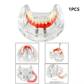 1 Cái Trên / Dưới Mô Hình Cấy Ghép Nha Khoa Hàm 2 / 4 / 6 Cấy Răng Mô Hình Giảng Dạy Nha Khoa Có Thể Tháo Rời Mô Hình Nghiên Cứu Cho Giáo Dục Demo