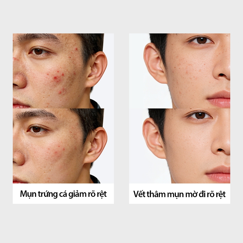 ✨Hàng Mới Về✨[UNO] Sữa rửa mặt Hỗ trợ giảm mụn cho nam 120g | Công thức dành cho làn da chống mụn