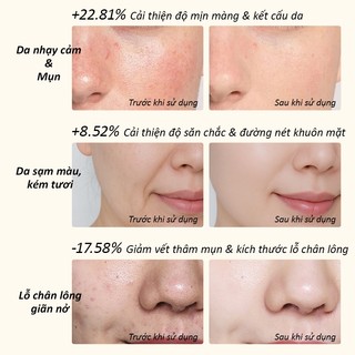 Mặt nạ ánh sáng sinh học NIPLFIE-EM-02 quang trị liệu bằng đèn LED, được chứng nhận FDA loại II