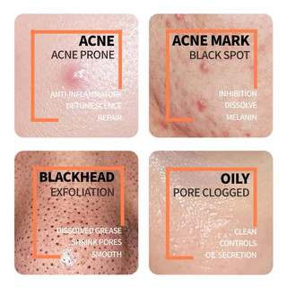 Ordinary Salicylic Acid Serum remover hidden acne, blackheads on the nose