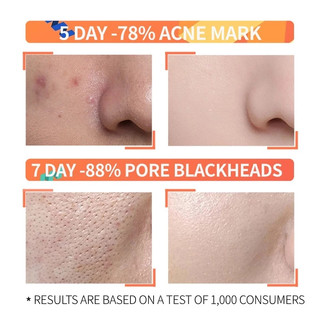 Ordinary Salicylic Acid Serum remover hidden acne, blackheads on the nose