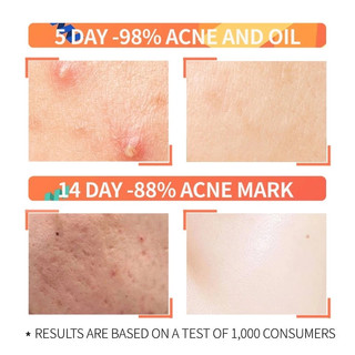Ordinary Salicylic Acid Serum remover hidden acne, blackheads on the nose