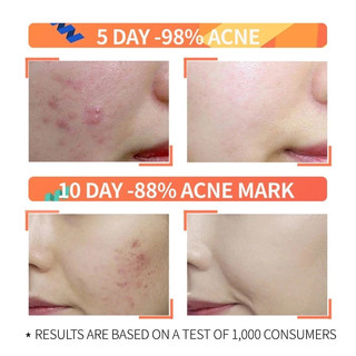 Ordinary Serum Axit Lactic tẩy tế bào chết da mặt và làm sáng da mặt chăm sóc da mặt