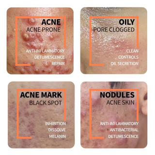 Kem tẩy mụn đầu đen Azelaic Acid thông thường làm mờ vết thâm mụn