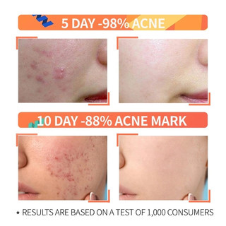 Kem tẩy mụn đầu đen Azelaic Acid thông thường làm mờ vết thâm mụn