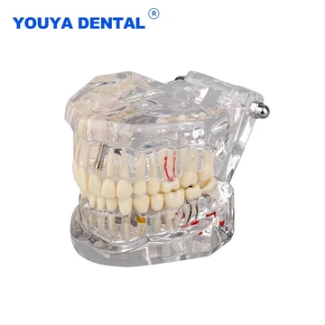 Mô hình răng cấy ghép bệnh nha sĩ Mô hình nghiên cứu với cầu phục hồi Mô hình trình diễn răng