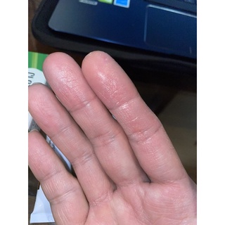 [Chỉ Bán Hàng Thái] Kem giảm nấm móng CLOTHASONE-D Cream 15 gram Thái Lan