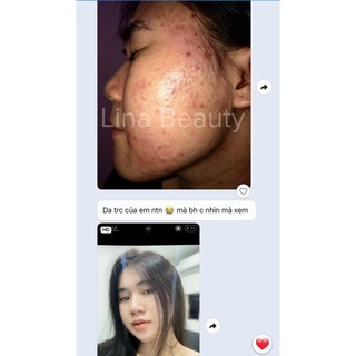 [MUA 3 TẶNG 1] Serum giảm mụn mờ thâm - YU SKIN - Công dụng 3 trong 1 hiệu quả sau 7 ngày