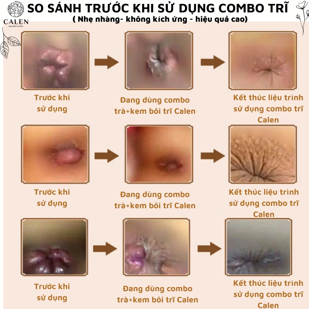 Kem bôi trĩ Calen Nature Farm giảm cơn đau trĩ, co se búi trĩ siêu nhanh hũ 10gram
