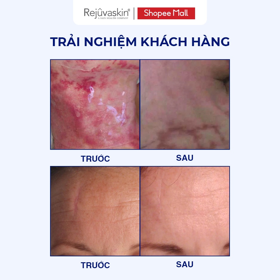 Mô tả Bộ sản phẩm ngăn ngừa sẹo lồi và sẹo phẫu thuật Rejuvaskin gel 10ml x 3.75*7.5cm - 5