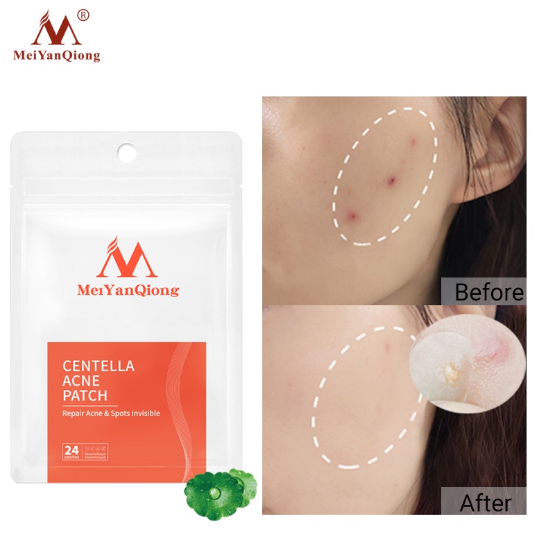 Ảnh MeiYanQiong Miếng dán lột mụn giảm mụn đầu đen Phục Hồi àm làm  sạch sâu Da cho vùng mũi 24 viên 2