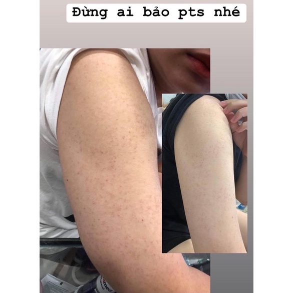 KELA LOTION DÙNG CHO VIÊM LỖ CHÂN LÔNG 30ml -60ml Thái Lan