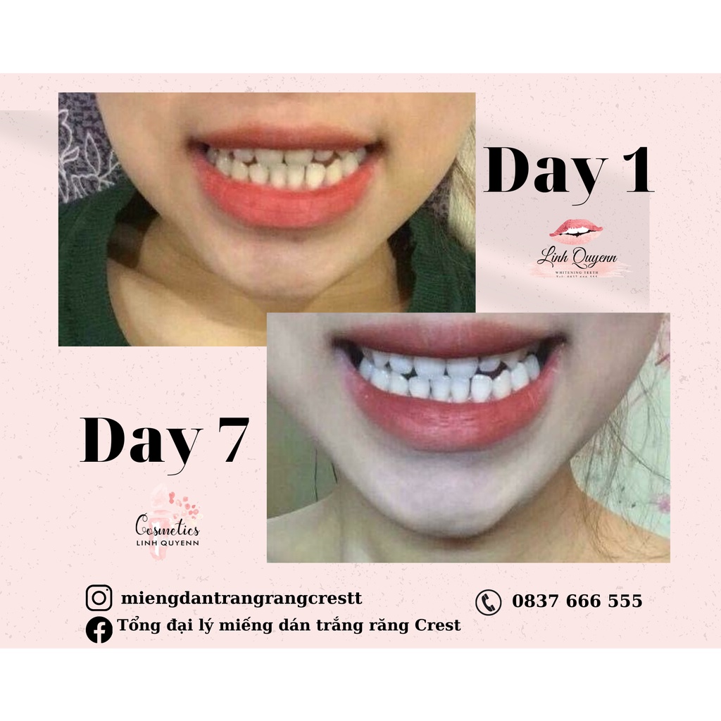 Combo 7 ngày Miếng dán trắng răng Crest
