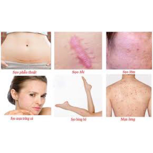 Kem mờ sẹo,kem loại bỏ sẹo lồi, lõm,thâm rạn da chỉ trong 2 tháng cam kết hàng cao cấp số 1 Nga)