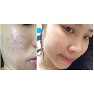 kem mờ sẹo klirvin nga kem xoá sẹo lồi lõm rỗ mờ thâm mụn rạn da ngừa mụn giảm thâm mắt [??̣̆?? ??́? ???????? ??̣̆?]