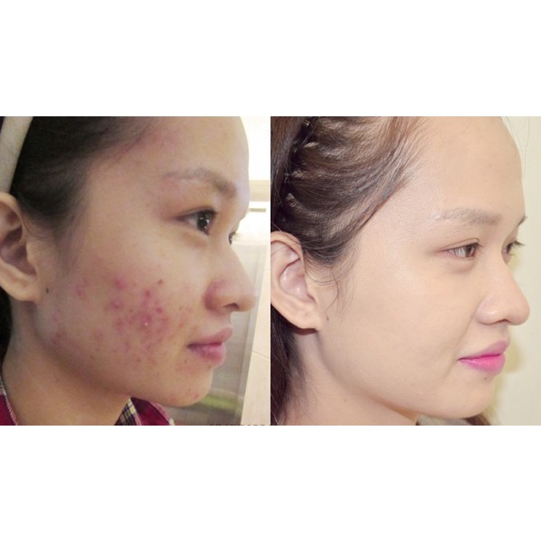 Derma Forte Kem Giảm Mụn Loại Bỏ Mụn Thâm, Mụn Trứng Cá, Làm Mờ Sẹo, Dưỡng Da
